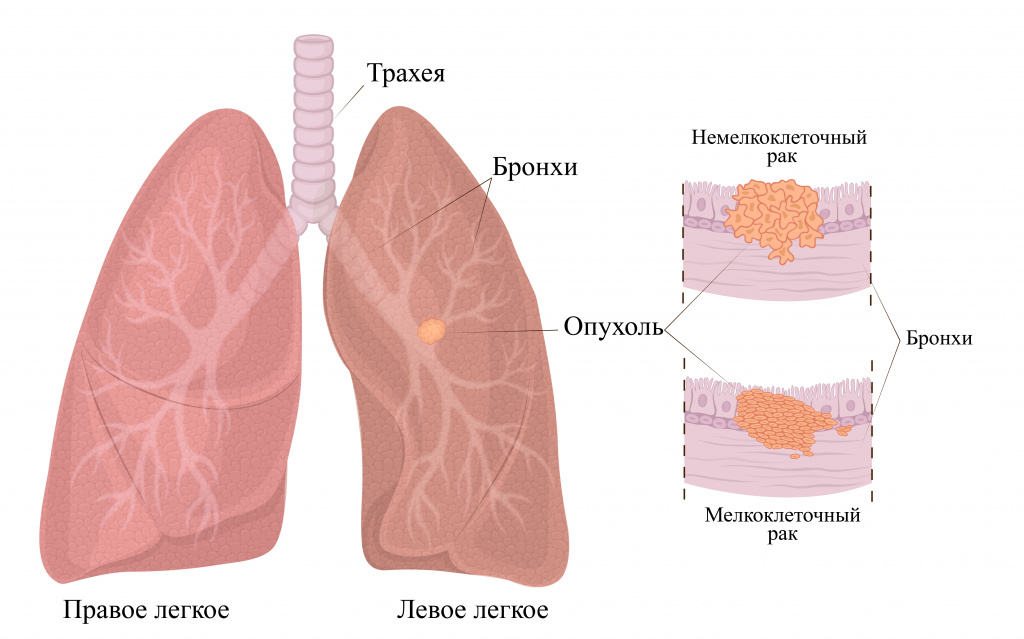 Удаление легкого как называется