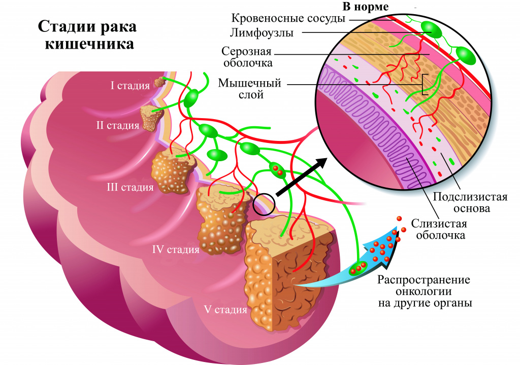 Уплотнение в кишечнике что это