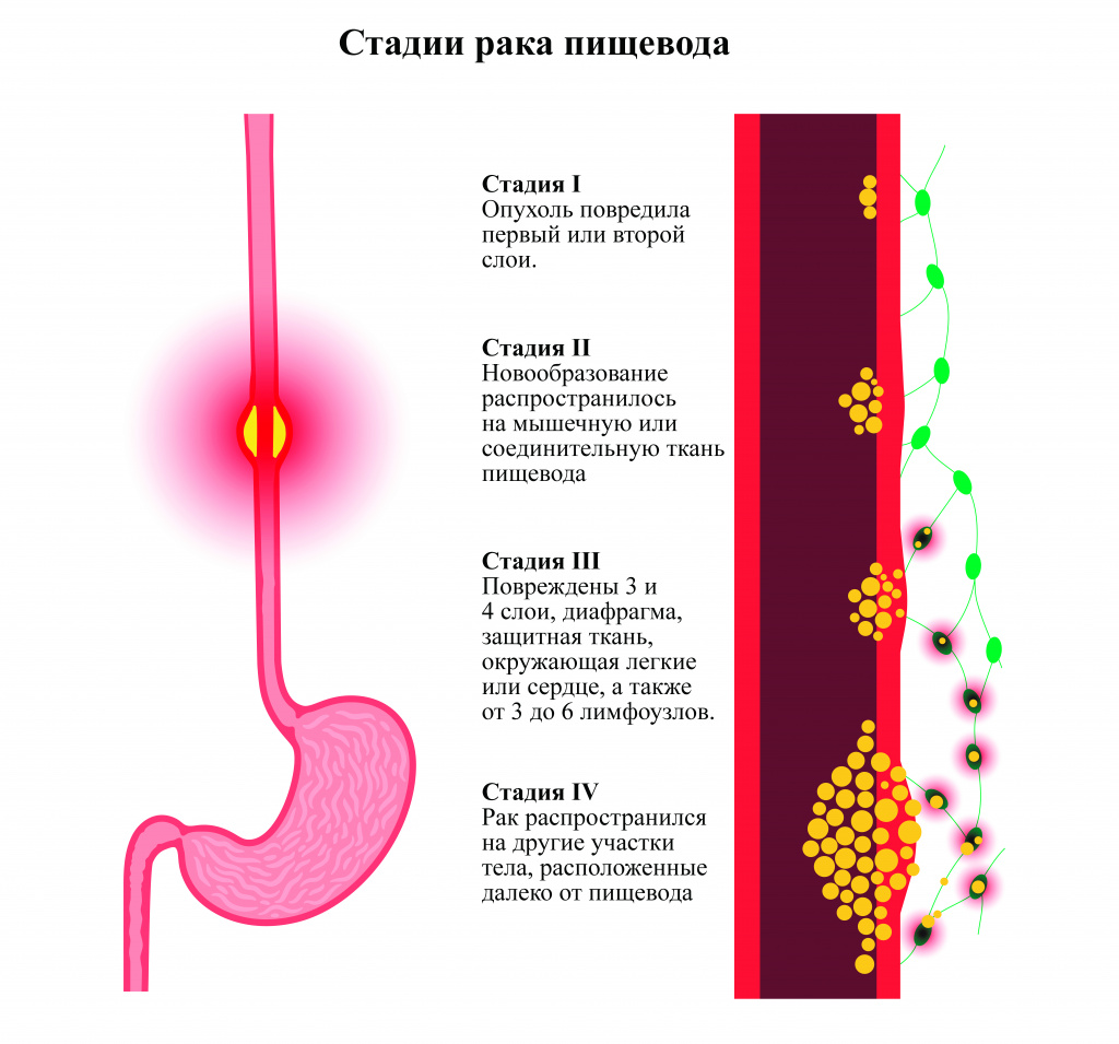 Рак пищевода: симптомы, признаки, диагностика и лечение