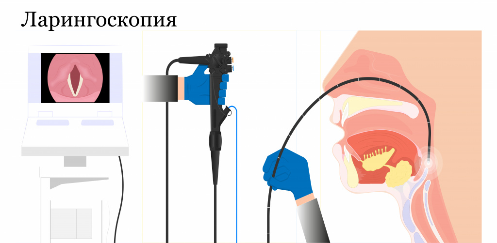 Ларингоскопия. Ларингоскопия в Ростове на Дону.