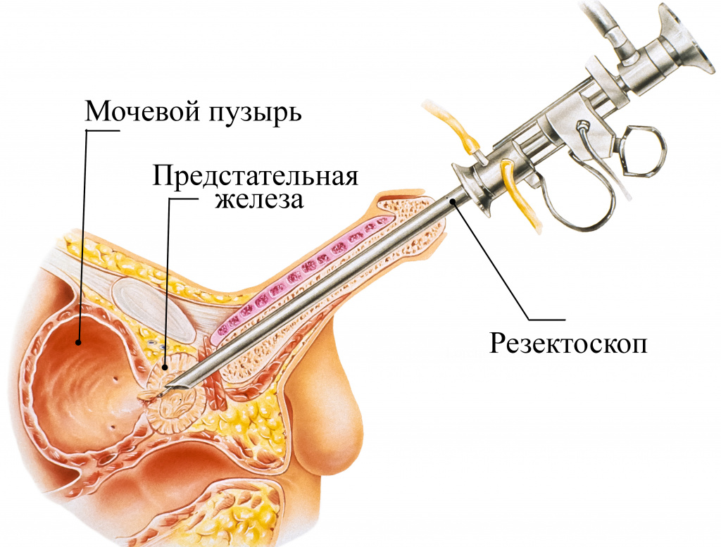 Трансуретральная резекция простаты